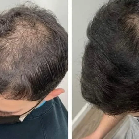hair loss treament